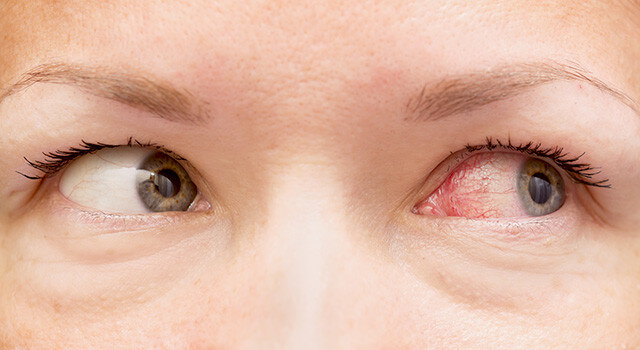 irritated eyes worry.jpg